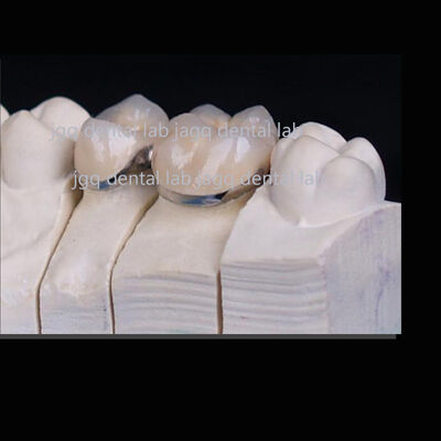 kopen Tandheelkundige legering van metaal Keramische kroon Tandheelkundige restauratie Porselein gesmolten metalen tanden online manufacture