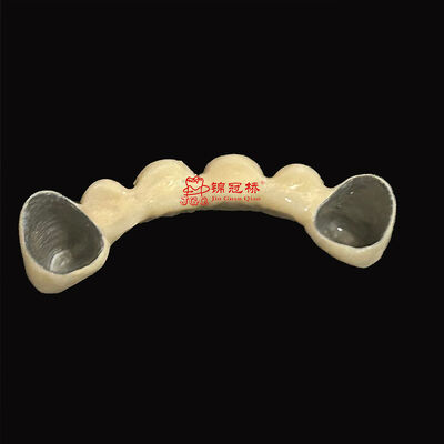 Buy Customized Pfm Titanium Teeth Durable Corrosion Resistant Ensuring Longevity online manufacture