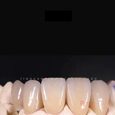 購入 Jgq Dental Lab が提供する、優れた耐久性と審美性を実現するために精密に作られたカスタマイズされた高品質ジルコニア義歯 online manufacture