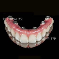 buy Implanted Dentures Manufacturer Customized Implant Teeth Bridge with Real Bite Sensation for Oral Restoration online manufacture