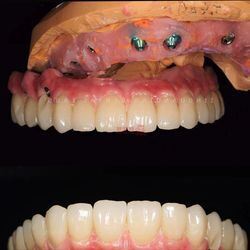 buy CE FDA Certified Superior Quality and Performance Dental Implants Zirconia Crowns and Customized Titanium Abutment online manufacture