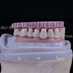 buy Dental Lab Durability Implants Make Cost-Effective Option in The Long Run online manufacture