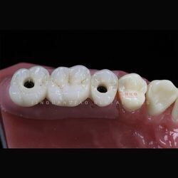 buy Customized Implant Teeth Bridge Implanting Guide Look Like Natural Teeth Restore Oral Health, Function and Appearance online manufacture