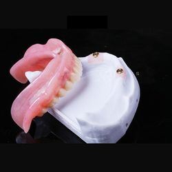 buy Ball-Cap Implant Overdenture Offers Excellent Stability and Retention Suitable for Elderly Patients Lab Prices online manufacture