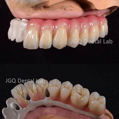 Buy All On 6 Dental Implants Fixed Dentures Dental Lab All Ceramic FDA CE Certificated online manufacture