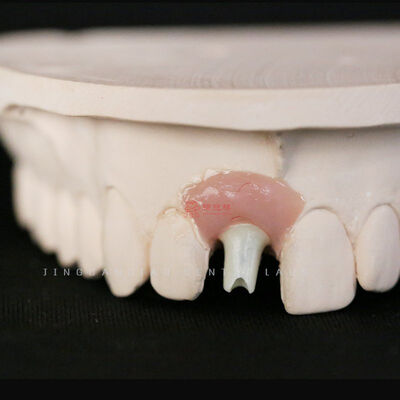 comprar Corona Dental Personalizada Retenida por Tornillo para Implantes Prótesis Híbridas de Zirconio Pilares Angulados Laboratorio China online manufacture