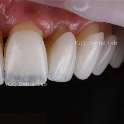 Buy E.max All Ceramic Dental High Translucency China Dental Lab online manufacture