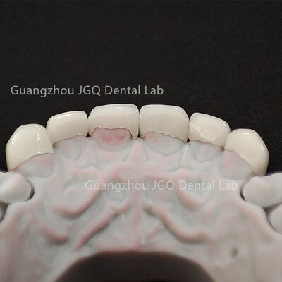 Buy Customized Dental Laminate Veneers and Zirconia Crown with Fast Turnaround and Biocompatible Materials online manufacture