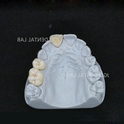 ซื้อ เซอร์โคเนียโมโนลิธิกความแข็งแรงสูง การบูรณะที่มั่นคง ราคาแข่งขันได้ ห้องปฏิบัติการทันตกรรมจีน online manufacture