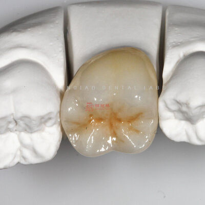 kaufen Medizinische Dentalzirkonoxid-Restauration Präzisions-CNC-Fräsen Kundenspezifisch online manufacture