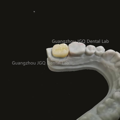 Beli Jasa Laboratorium Gigi Bersertifikat untuk Mahkota dan Jembatan Zirkonia Kustom, Layanan Restorasi Gigi Lengkap online manufacture