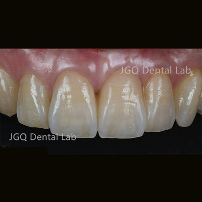 comprare Corona e ponte in zirconio estetico fresati CNC spedizione veloce alta precisione online manufacture