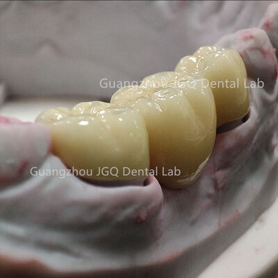 주문 높은 부러지기 저항성 Zirconia 왕관 다리 CNC 브룩시즘에 대한 무거운 폐쇄 online manufacture