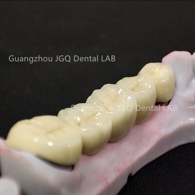 Buy Oral Restorations Pfm Teeth 3D Laser Printing Ultra Durable online manufacture