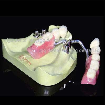 Mua Vương miện nha khoa kính thiên văn độ chính xác cao trượt chính xác với răng acrylic thiết lập online manufacture