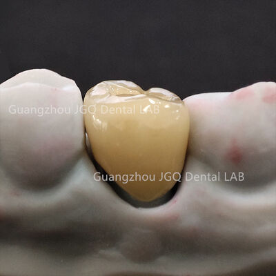 comprare Corone in Metallo-Ceramica Protesi Fissa Personalizzata Ponte Lungo PFM Stampa Laser 3D online manufacture