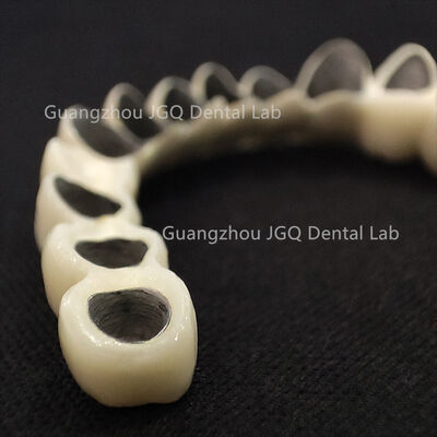 Buy Durable Fixed Dentures Metal Ceramic Bridge For Dental Restorations online manufacture